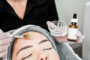 chemical peel in luton
