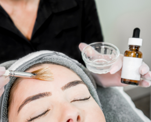 chemical peel in luton